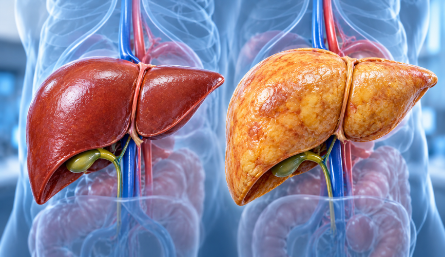 Fatty Liver Disease Treatment and Care