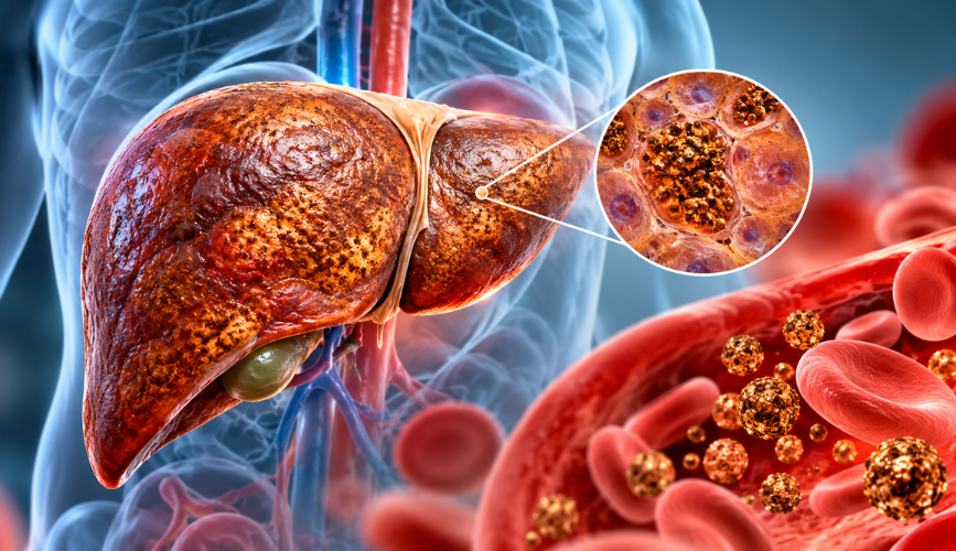 Hemochromatosis Iron Overload Treatment